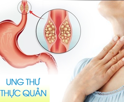 Lời khuyên với các bệnh nhân ung thư thực quản về đề điều trị đa mô thức